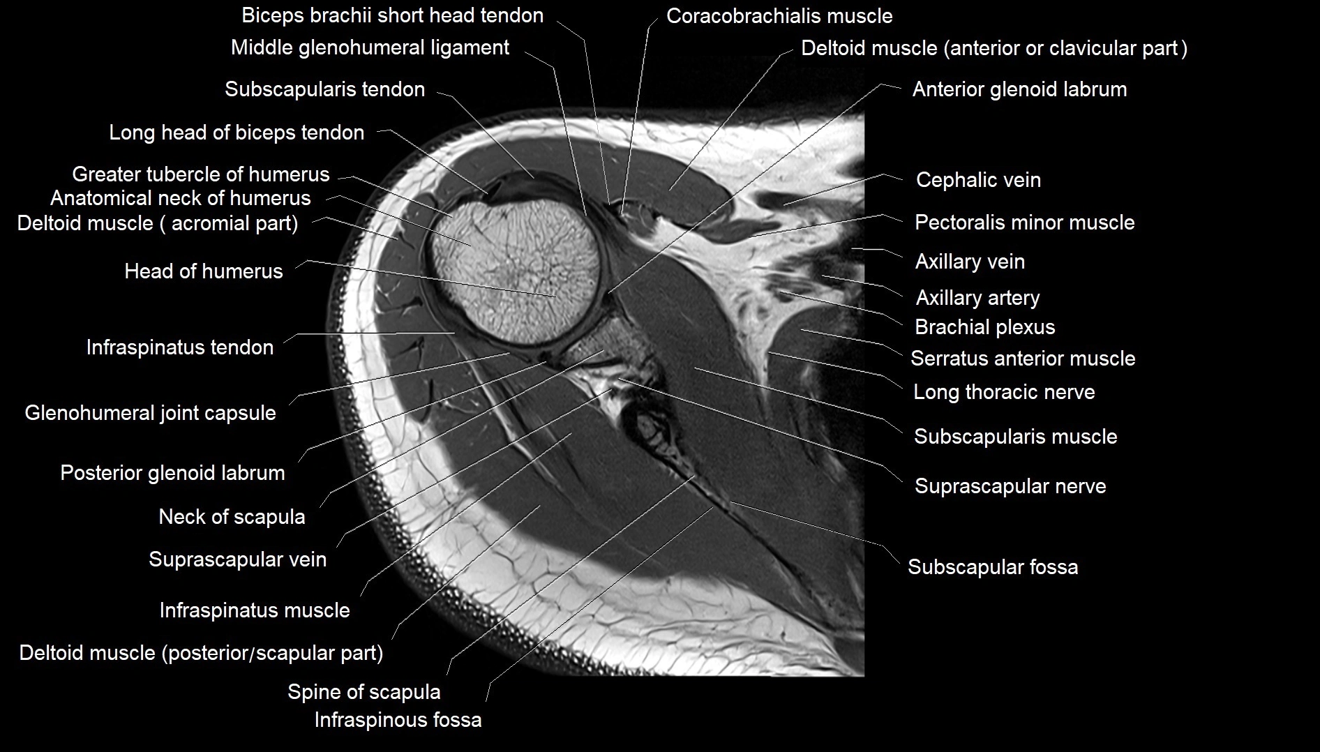 Shoulder cross sectional anatomy MRI 3T axial image 16.webp